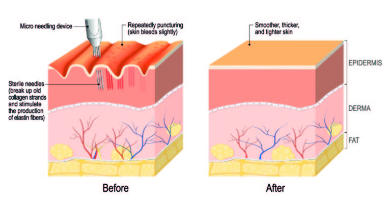 Microneedling by Dermatopigmentatie