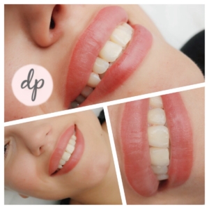 Dermatopigmentatie bardot lips 2