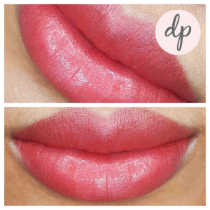 Dermatopigmentatie bardot lips 2