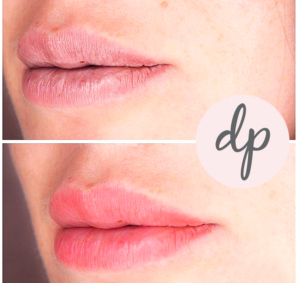 Dermatopigmentatie baby lips 1