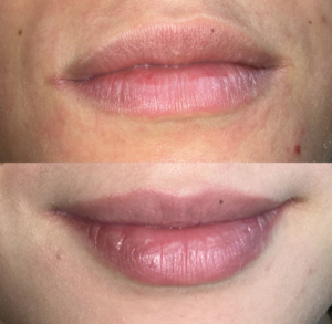 Dermatopigmentatie baby lips lippigmentatie voor en na resultaat