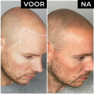 Dermatopigmentatie microhaarpigmentatie voor en na man zijkant rechts